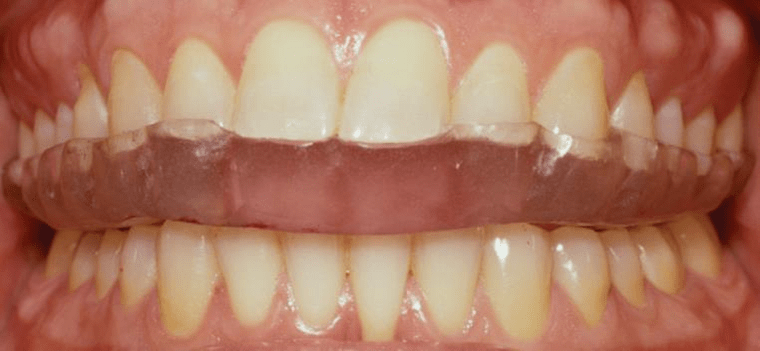 Férula o dispositivo oclusal individualizado para cada paciente.